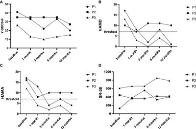 Telemedicine in patients with obsessive–compulsive disorder after deep brain stimulation: a case series